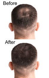 Image of Man before and after hair treatment on white background, collage. Back view
