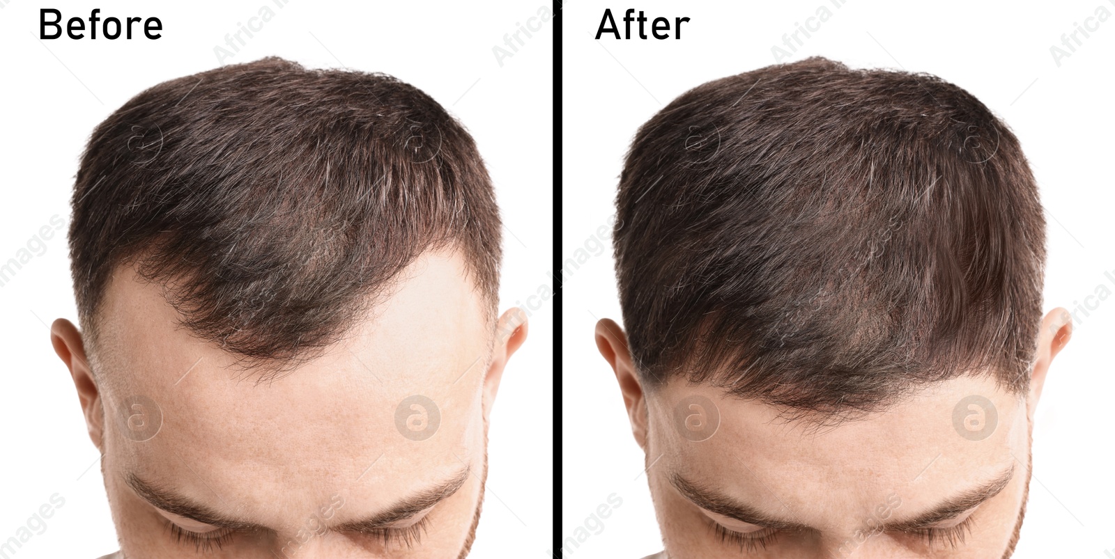 Image of Man before and after hair treatment on white background, collage