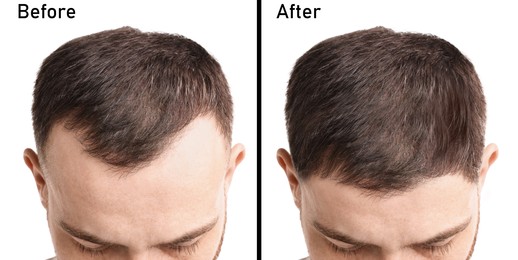 Image of Man before and after hair treatment on white background, collage