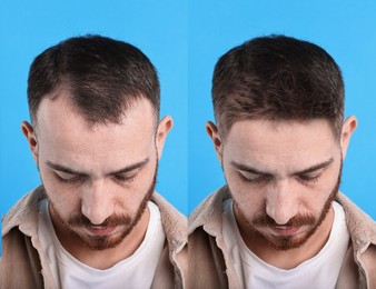 Image of Man before and after hair treatment on blue background, collage
