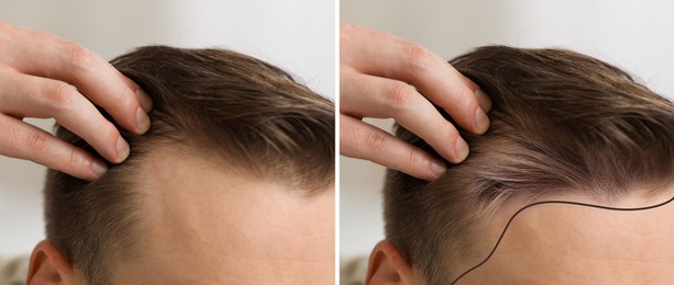 Image of Man before and after hair treatment on white background, collage