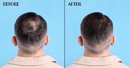 Image of Man before and after hair treatment on light blue background, collage. Back view
