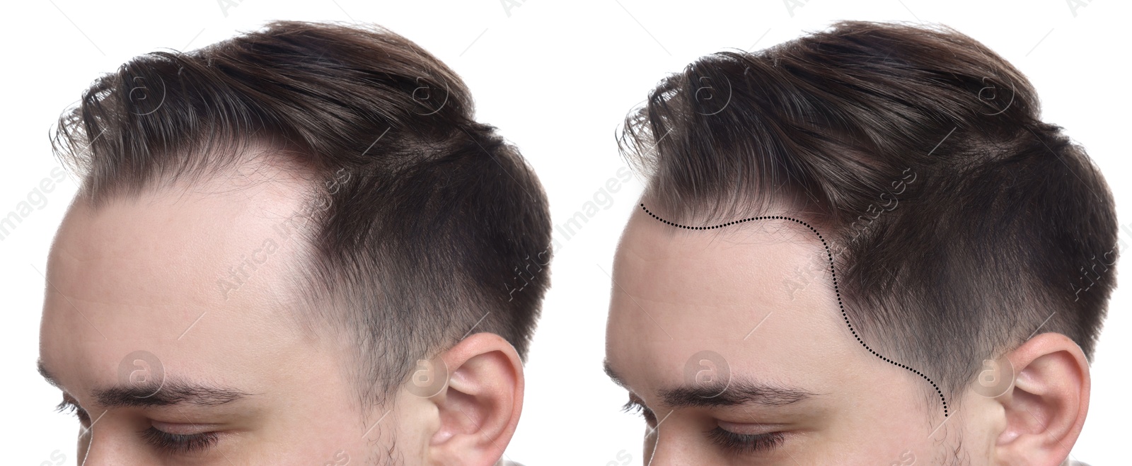 Image of Man before and after hair treatment on white background, collage