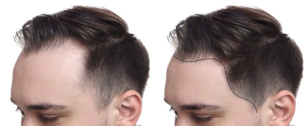 Image of Man before and after hair treatment on white background, collage