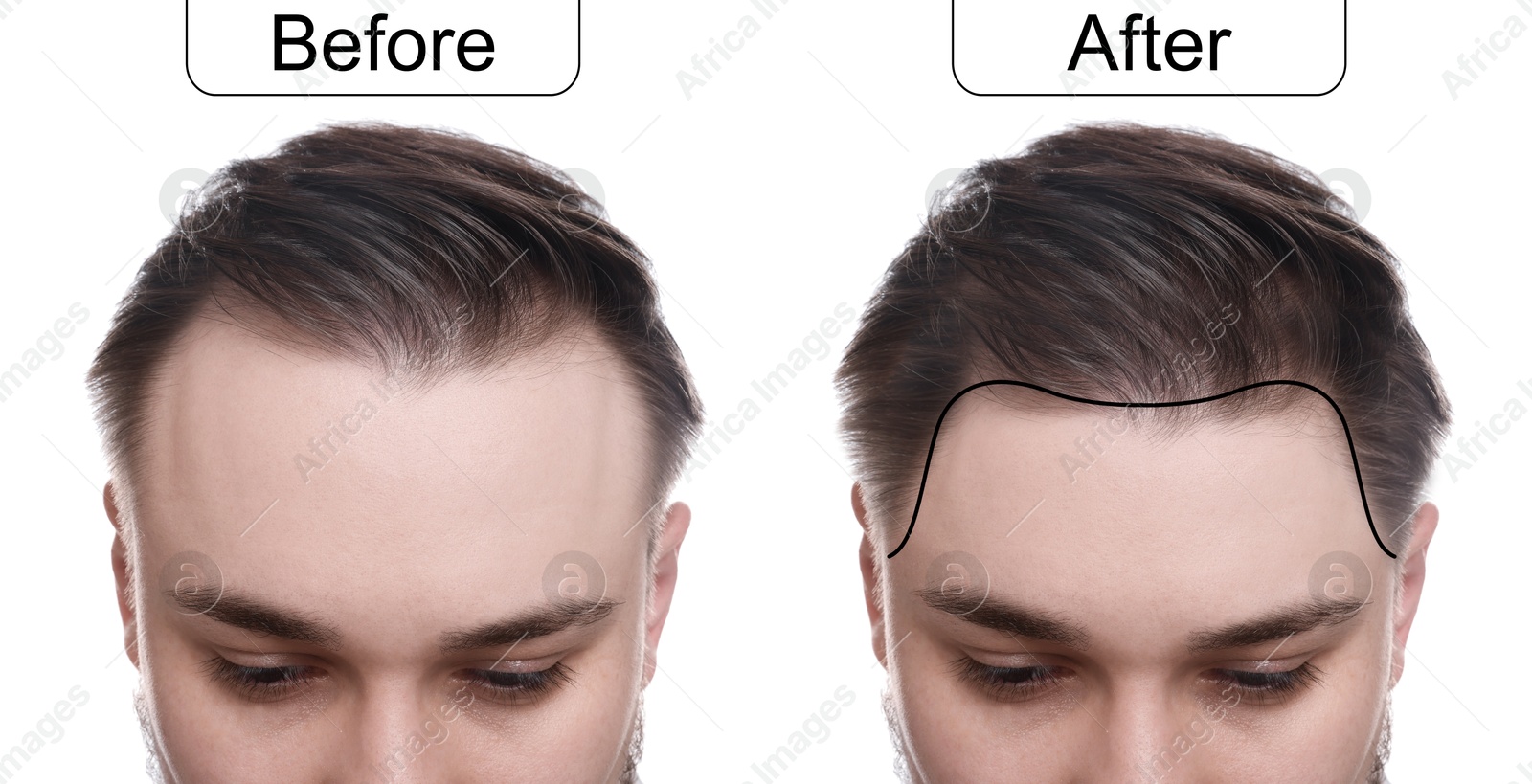 Image of Man before and after hair treatment on white background, collage