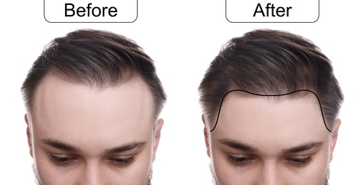 Image of Man before and after hair treatment on white background, collage