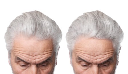Image of Man before and after hair treatment on white background, collage