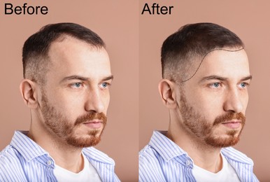 Image of Man before and after hair treatment on beige pink background, collage