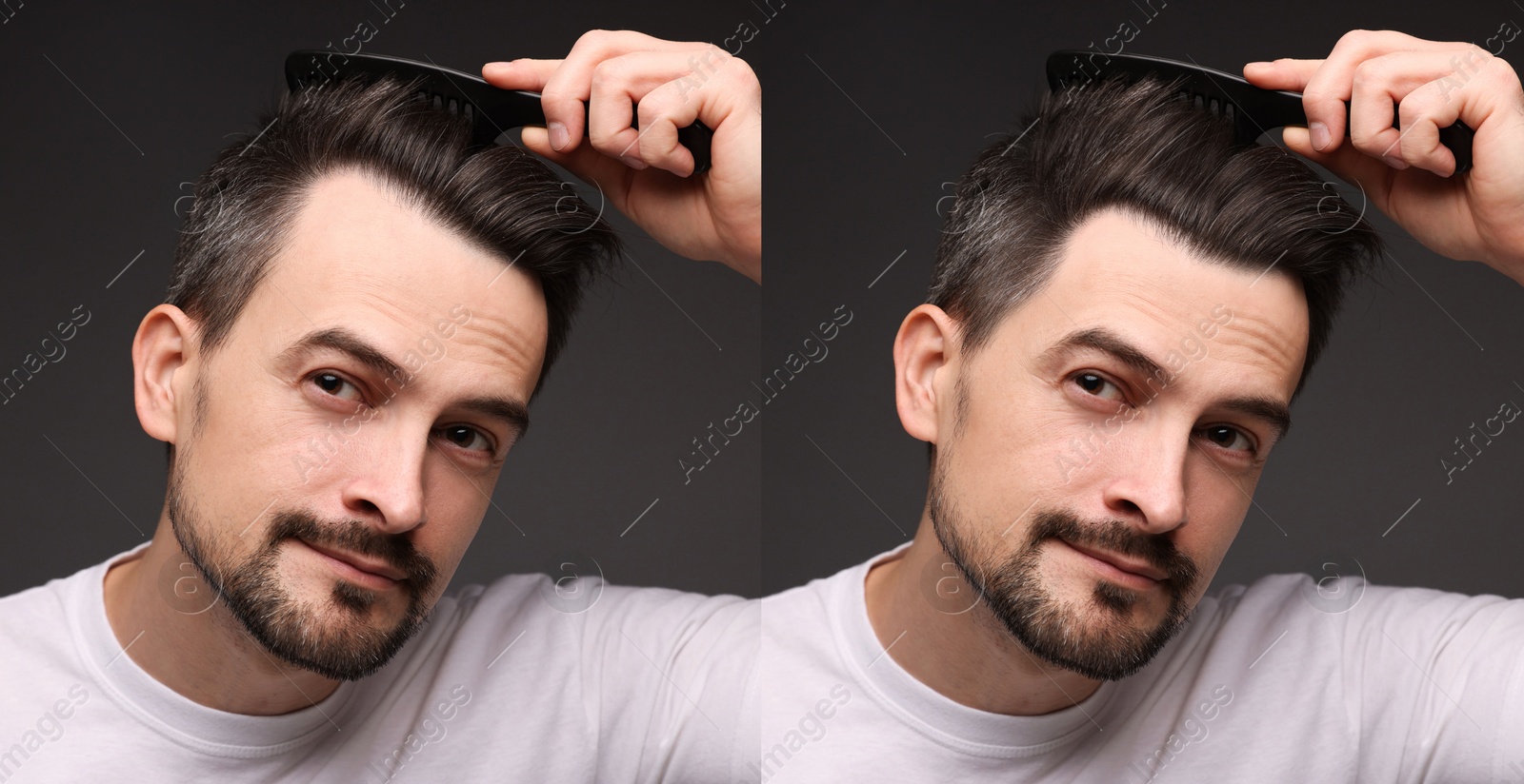 Man before and after hair treatment on dark grey background, collage Image of Man before and after hair treatment on dark grey background, collage