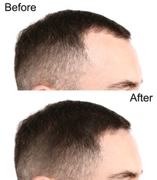 Image of Man before and after hair treatment on white background, collage