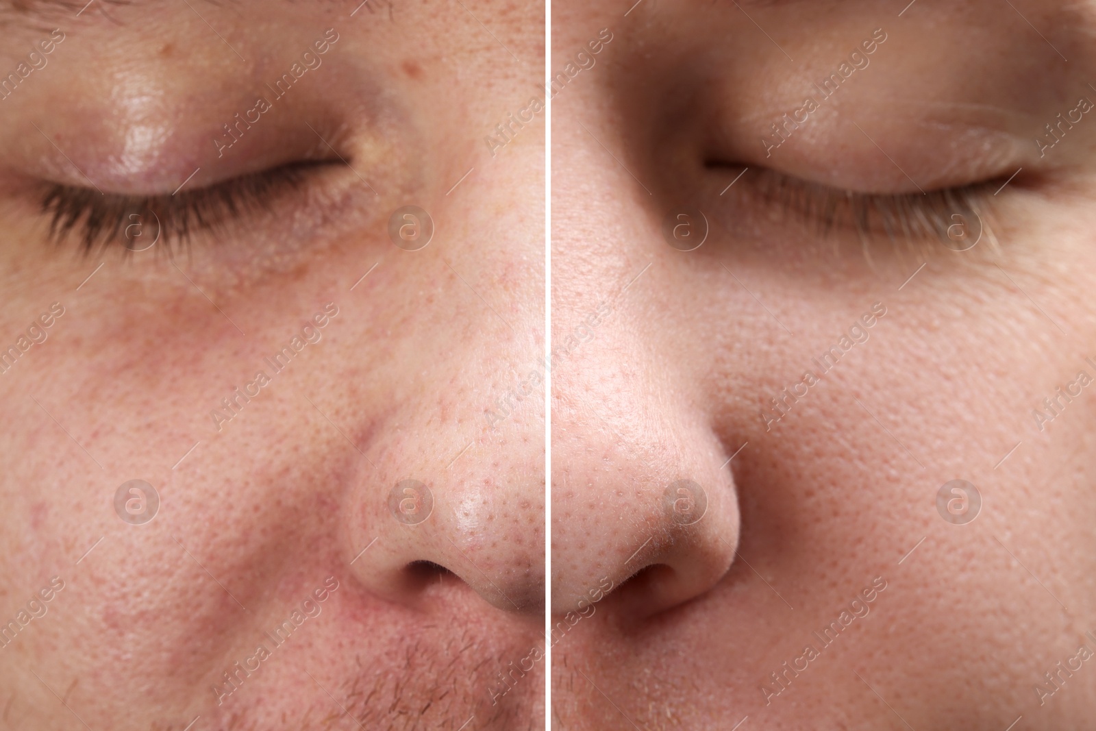 Image of Before and after collage. Photo of man divided in halves showing different skin condition, closeup