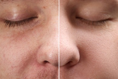 Image of Before and after collage. Photo of man divided in halves showing different skin condition, closeup