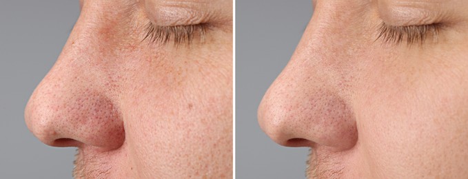 Image of Man showing his face before and after skin care treatment, closeup. Collage