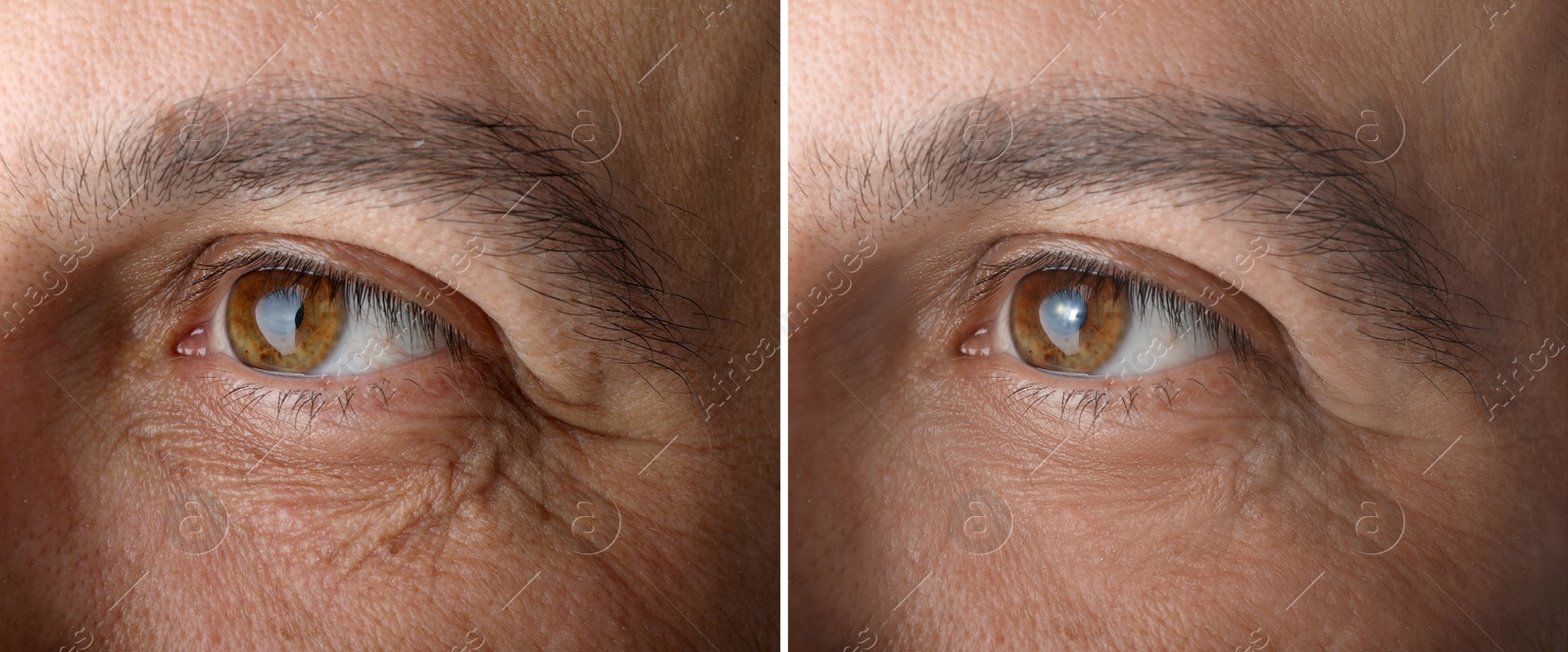 Image of Man showing his face before and after anti-aging treatment, closeup. Collage