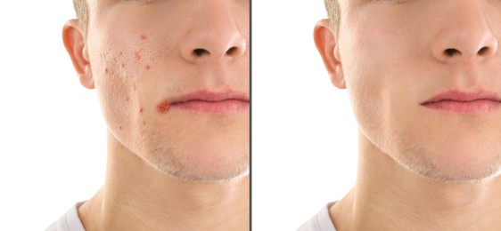 Image of Man with acne problem showing his face before and after skin care treatment, closeup. Collage