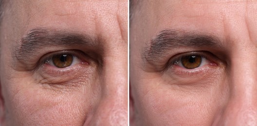 Image of Man showing his face before and after anti-aging treatment, closeup. Collage