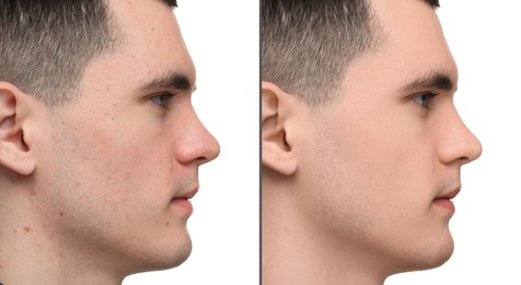 Image of Man with acne problem showing his face before and after skin care treatment, closeup. Collage