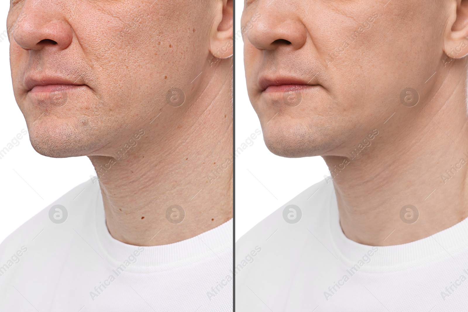 Man showing his face before and after skin care treatment, closeup. Collage Image of Man showing his face before and after skin care treatment, closeup. Collage