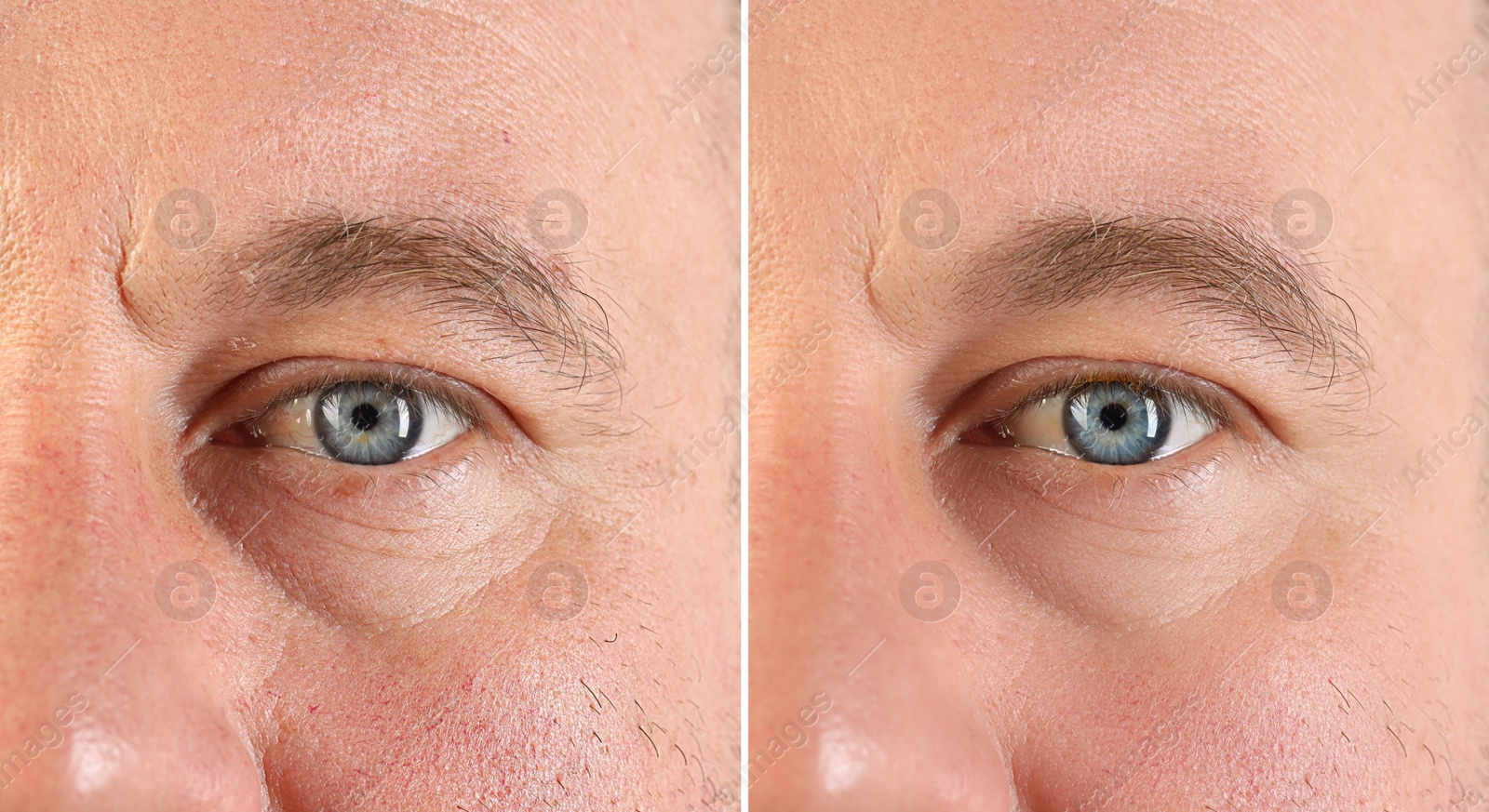 Image of Man showing his face before and after skin care treatment, closeup. Collage