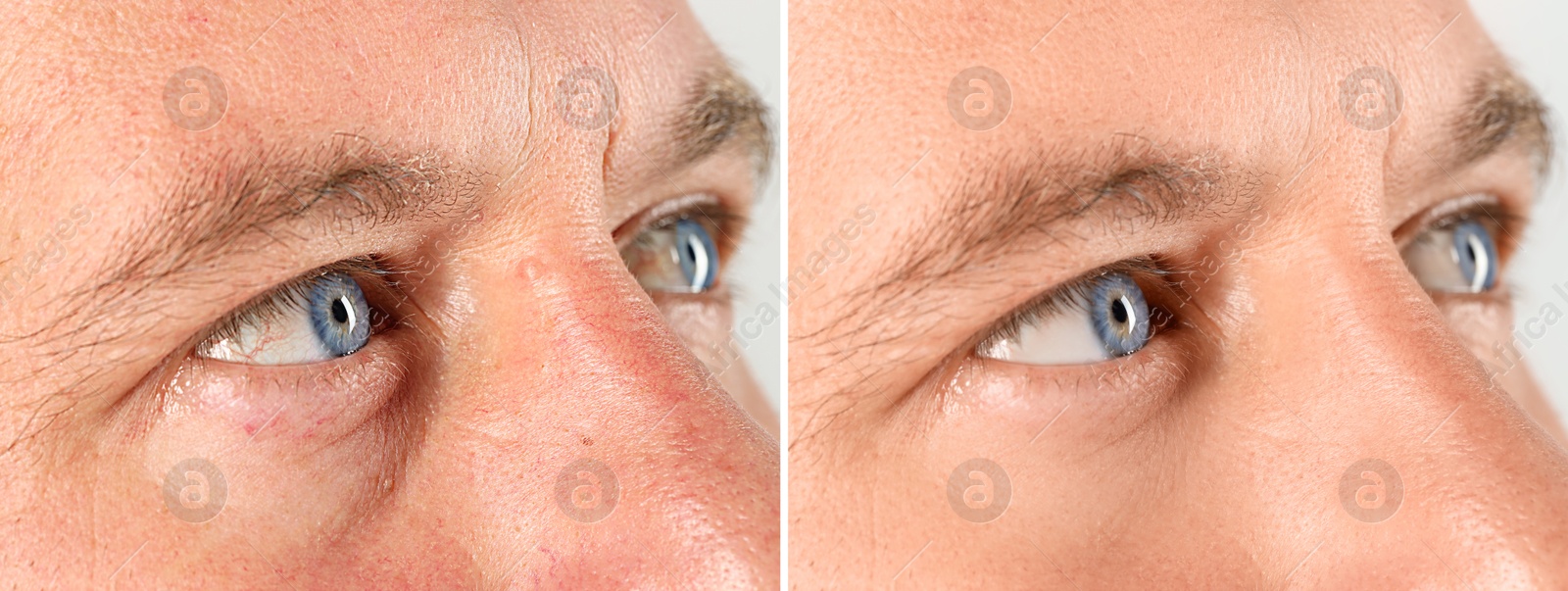 Image of Man showing his face before and after anti-aging treatment, closeup. Collage