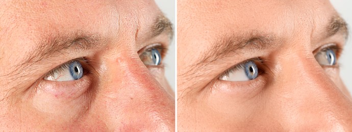 Image of Man showing his face before and after anti-aging treatment, closeup. Collage