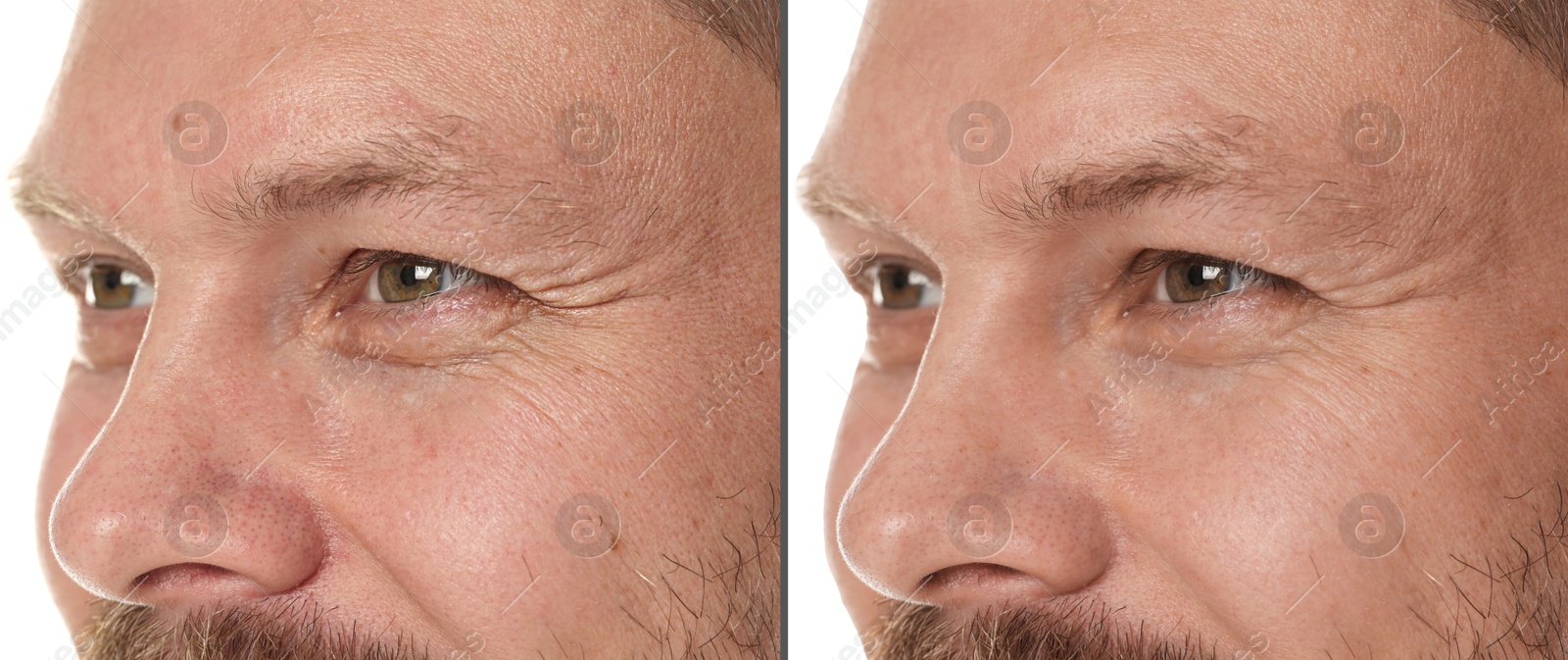 Image of Man showing his face before and after skin care treatment, closeup. Collage