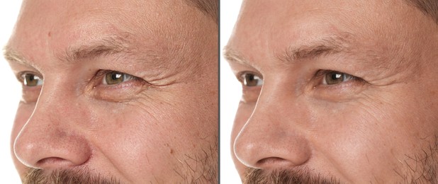Image of Man showing his face before and after skin care treatment, closeup. Collage
