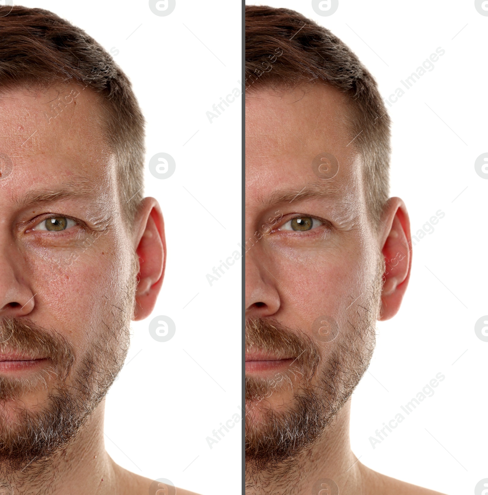 Image of Man showing his face before and after skin care treatment, closeup. Collage
