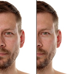 Image of Man showing his face before and after skin care treatment, closeup. Collage