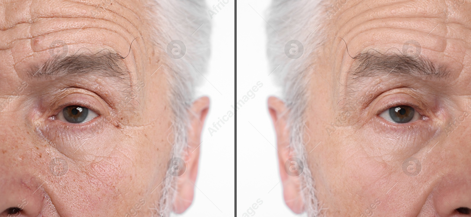 Image of Senior man showing his face before and after skin care treatment, closeup. Collage