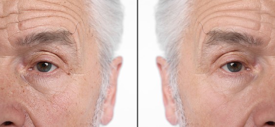 Image of Senior man showing his face before and after skin care treatment, closeup. Collage