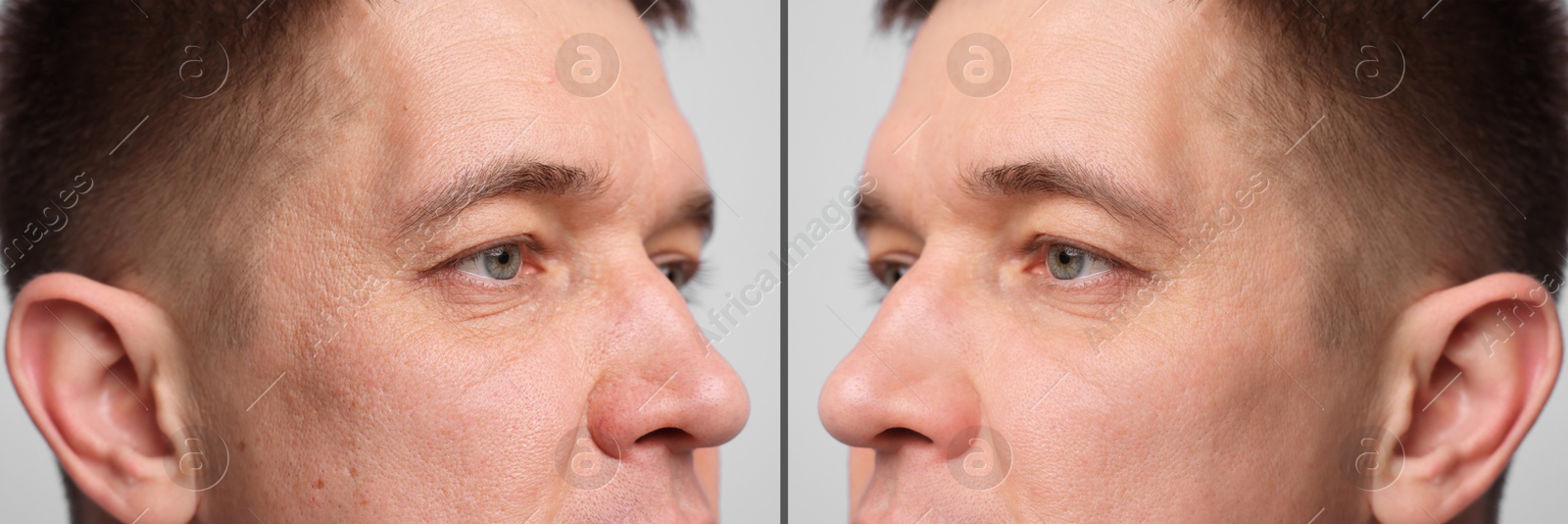 Man showing his face before and after skin care treatment, closeup. Collage Image of Man showing his face before and after skin care treatment, closeup. Collage