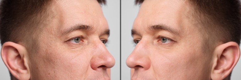 Image of Man showing his face before and after skin care treatment, closeup. Collage