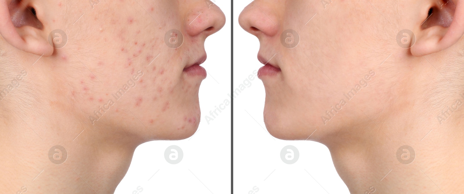 Image of Man with acne problem showing his face before and after skin care treatment, closeup. Collage