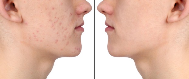 Image of Man with acne problem showing his face before and after skin care treatment, closeup. Collage