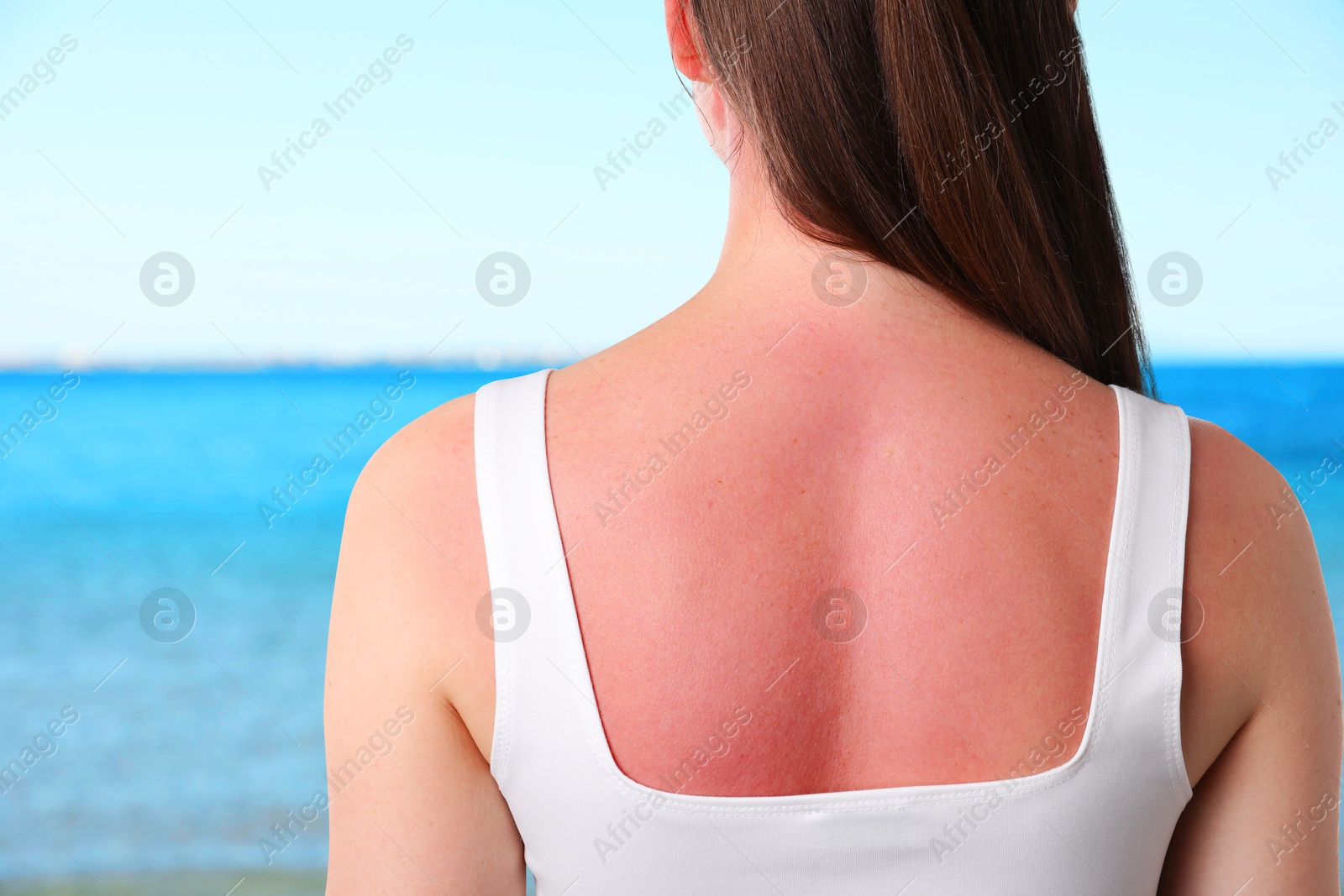 Woman with sunburned skin against sea, back view Image of Woman with sunburned skin against sea, back view