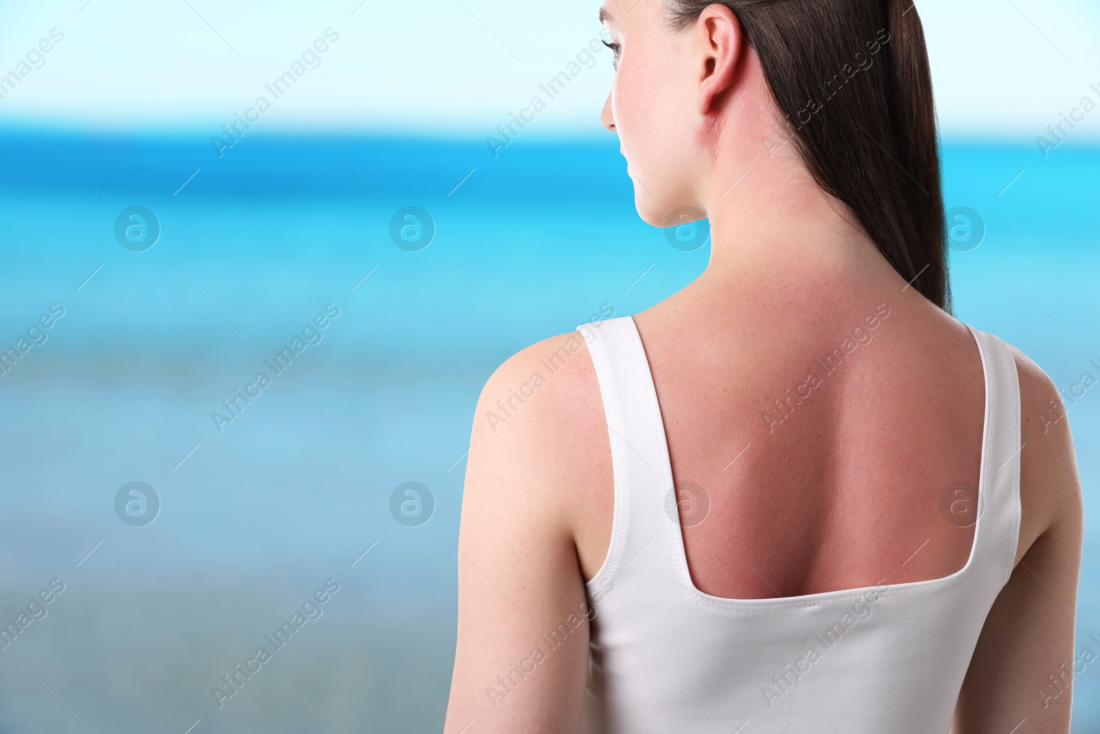 Woman with sunburned skin against sea, back view Image of Woman with sunburned skin against sea, back view