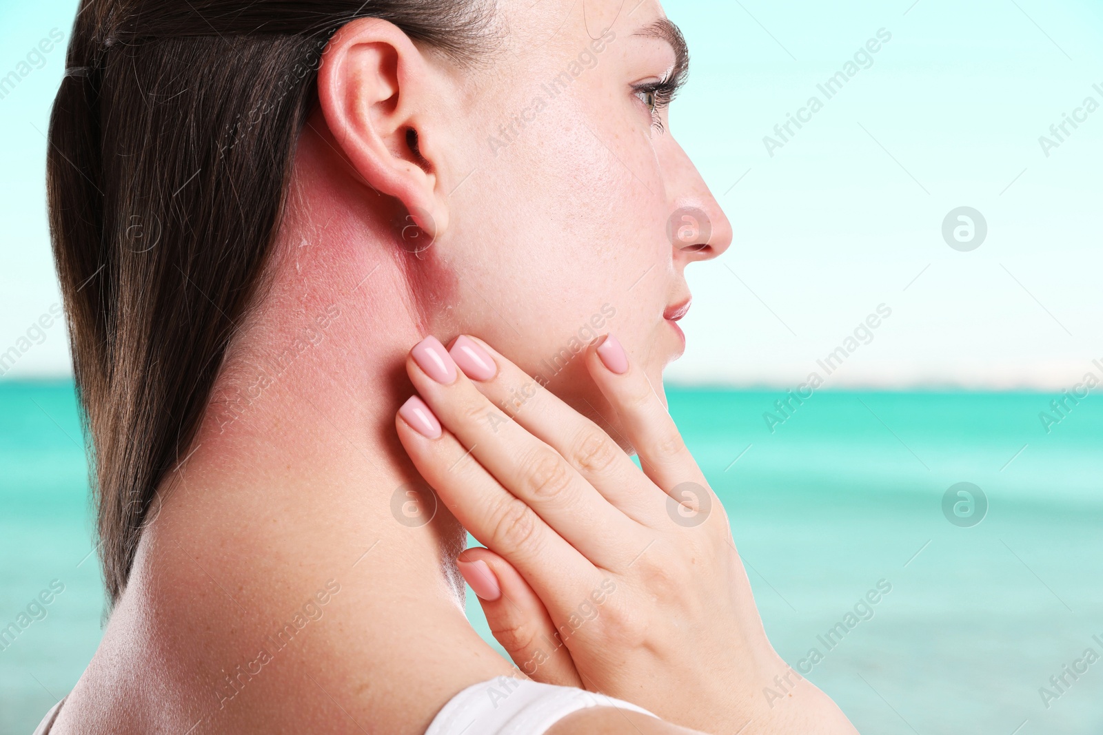 Woman with sunburned skin against sea, closeup Image of Woman with sunburned skin against sea, closeup