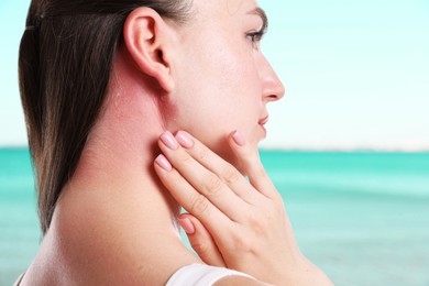 Image of Woman with sunburned skin against sea, closeup