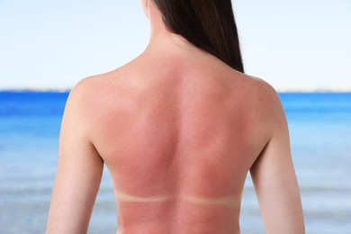 Image of Woman with sunburned skin against sea, back view