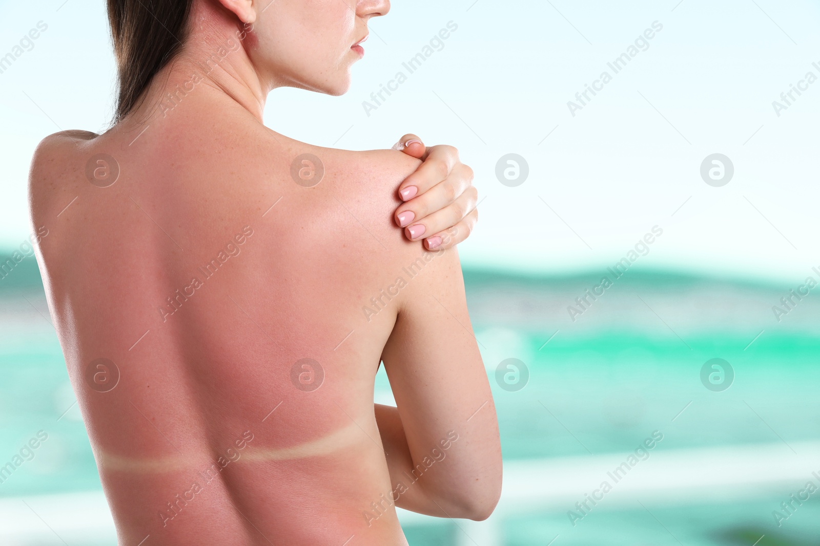 Woman with sunburned skin against sea, back view Image of Woman with sunburned skin against sea, back view