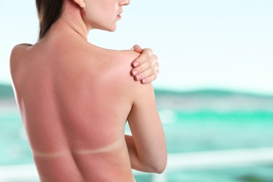 Image of Woman with sunburned skin against sea, back view