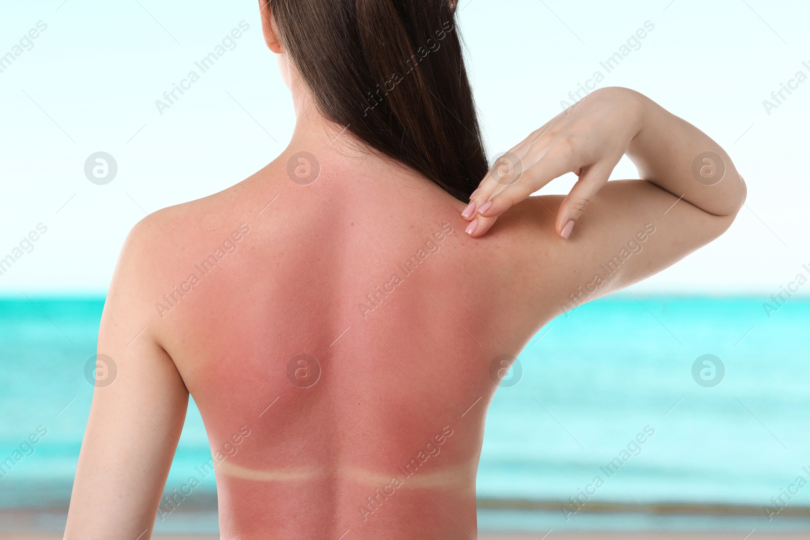 Woman with sunburned skin against sea, back view Image of Woman with sunburned skin against sea, back view