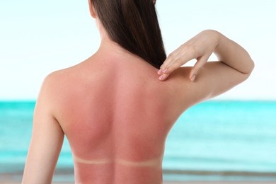 Image of Woman with sunburned skin against sea, back view