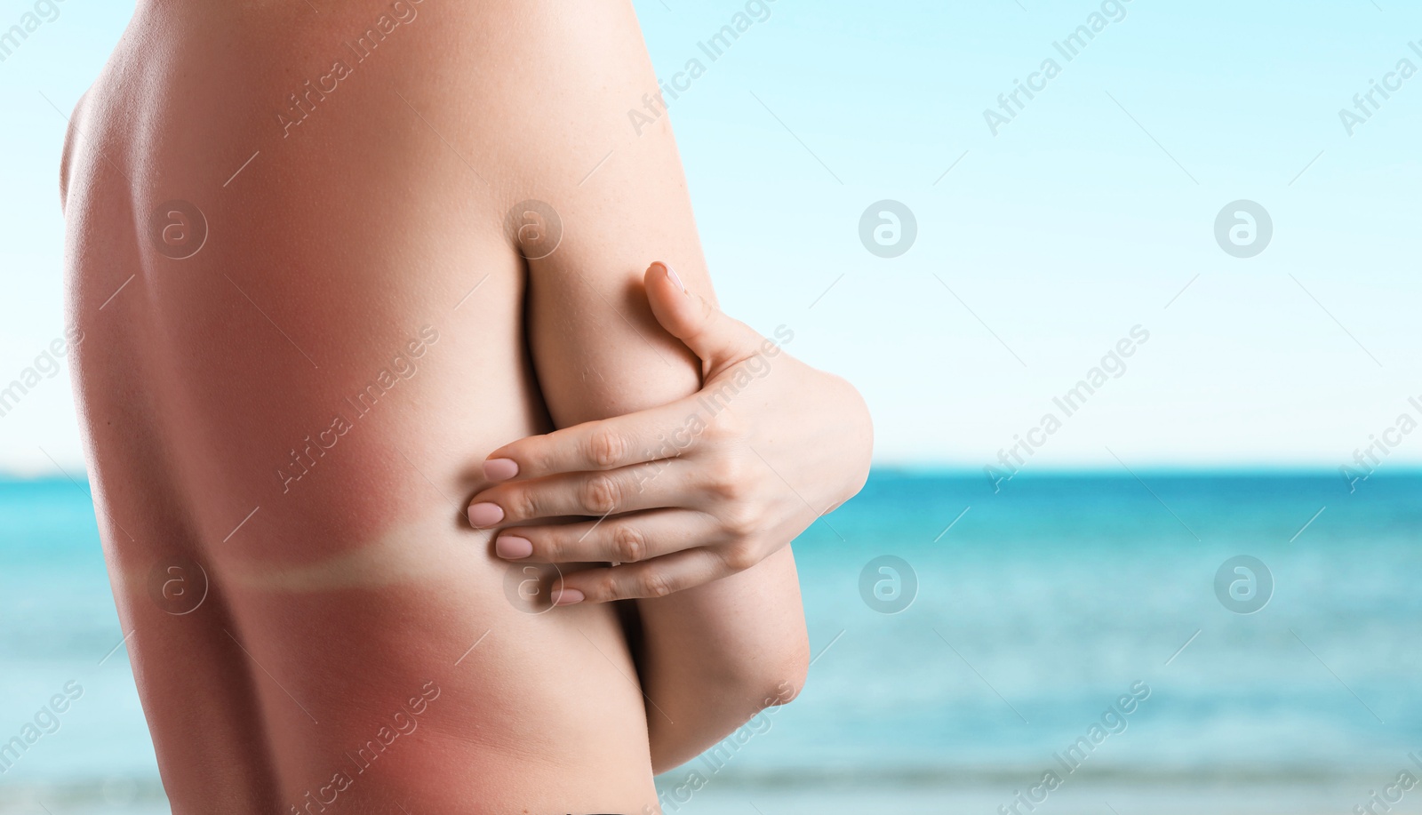 Woman with sunburned skin against sea, back view Image of Woman with sunburned skin against sea, back view