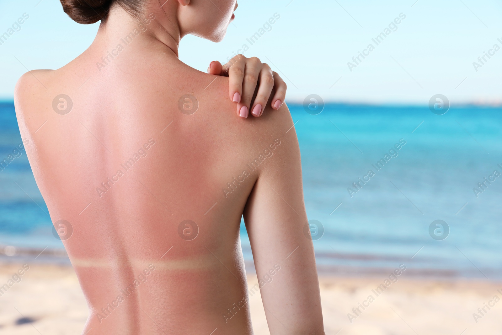 Woman with sunburned skin against sea, back view Image of Woman with sunburned skin against sea, back view
