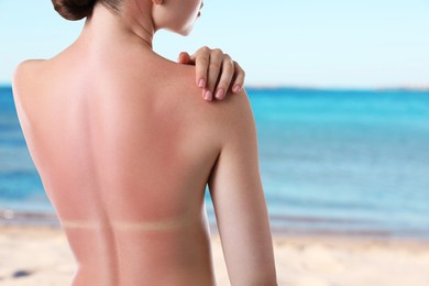 Image of Woman with sunburned skin against sea, back view