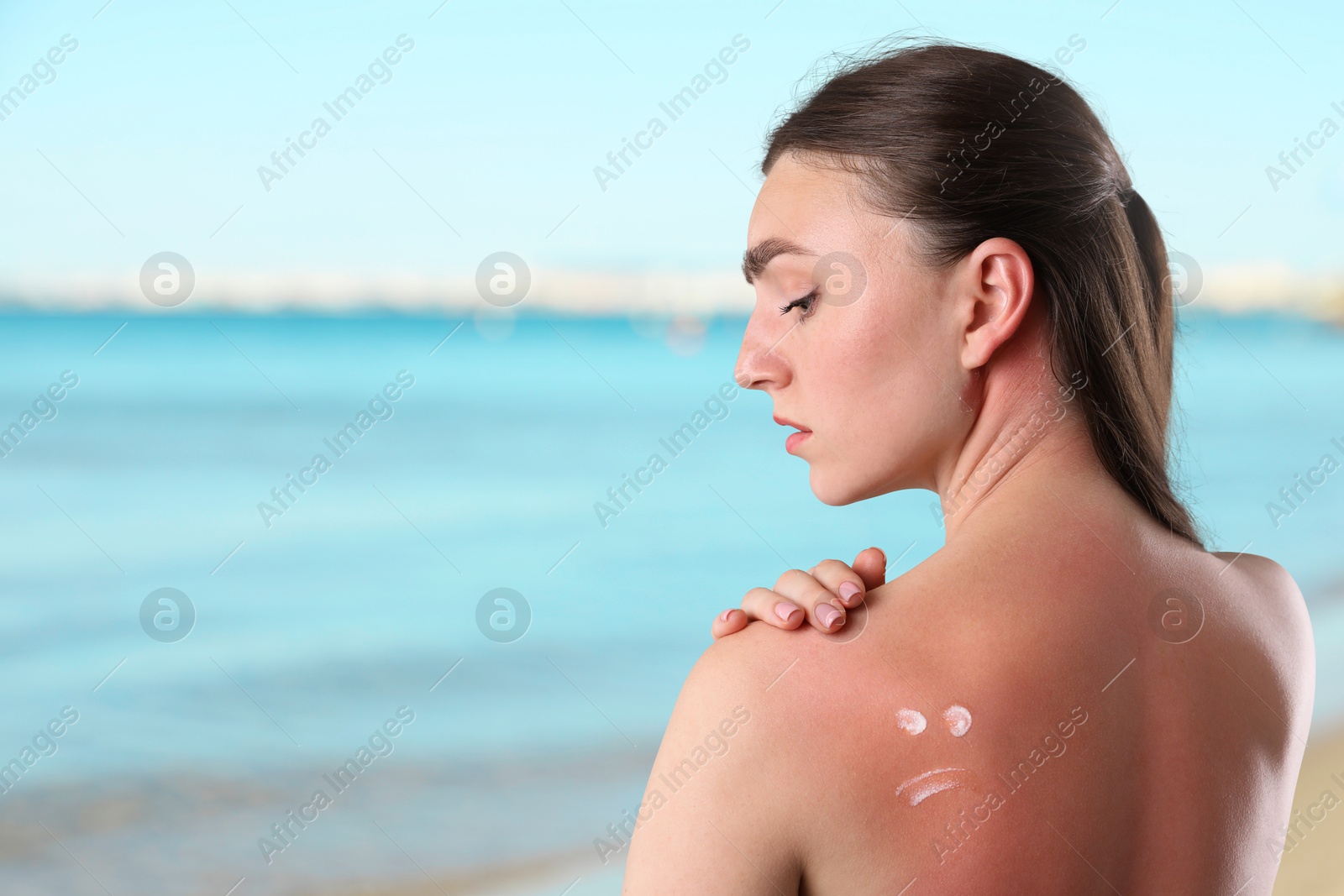 Woman with sunburned skin against sea. Smoothing cream on her shoulder Image of Woman with sunburned skin against sea. Smoothing cream on her shoulder