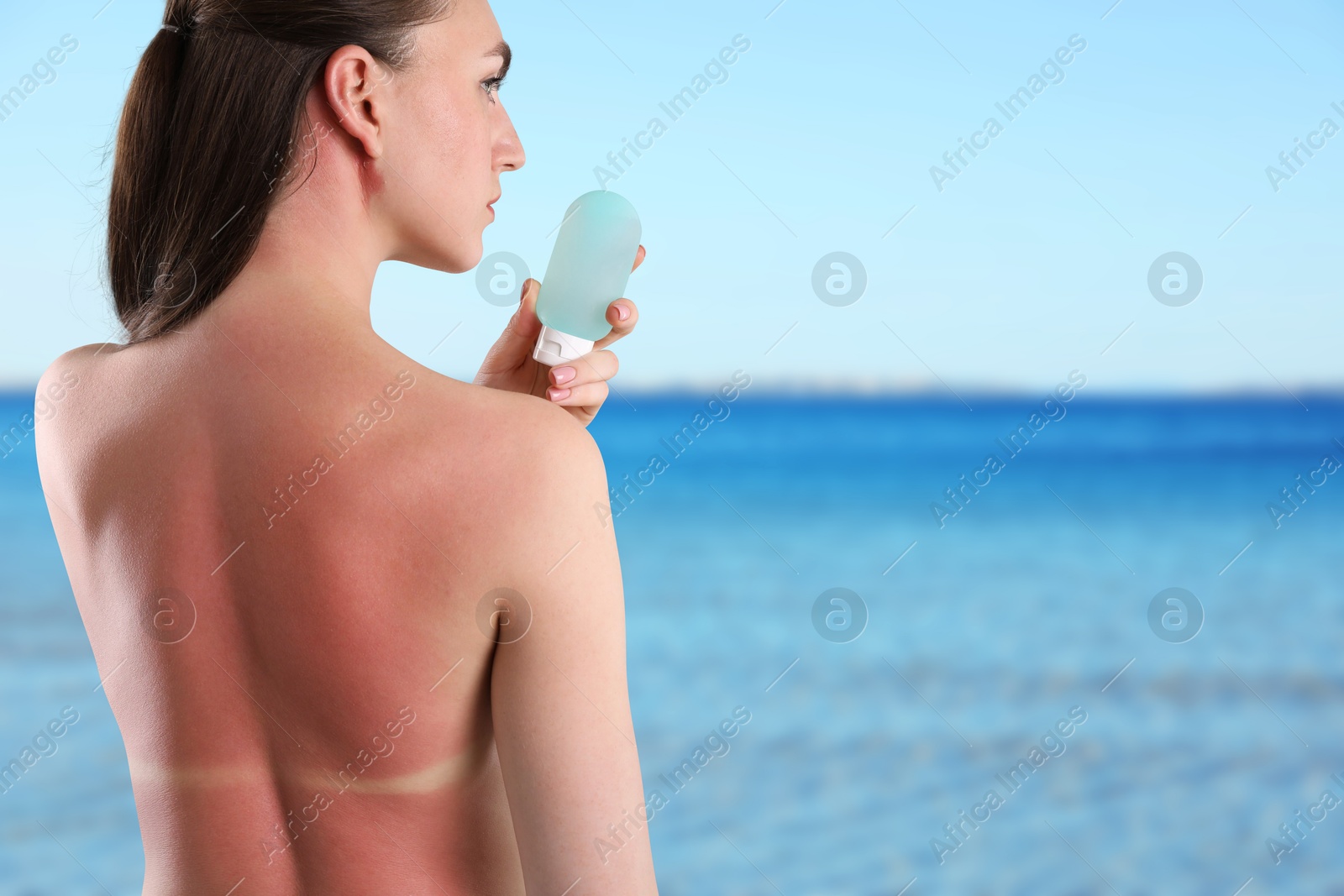Woman with sunburned skin holding smoothing cream against sea, back view Image of Woman with sunburned skin holding smoothing cream against sea, back view