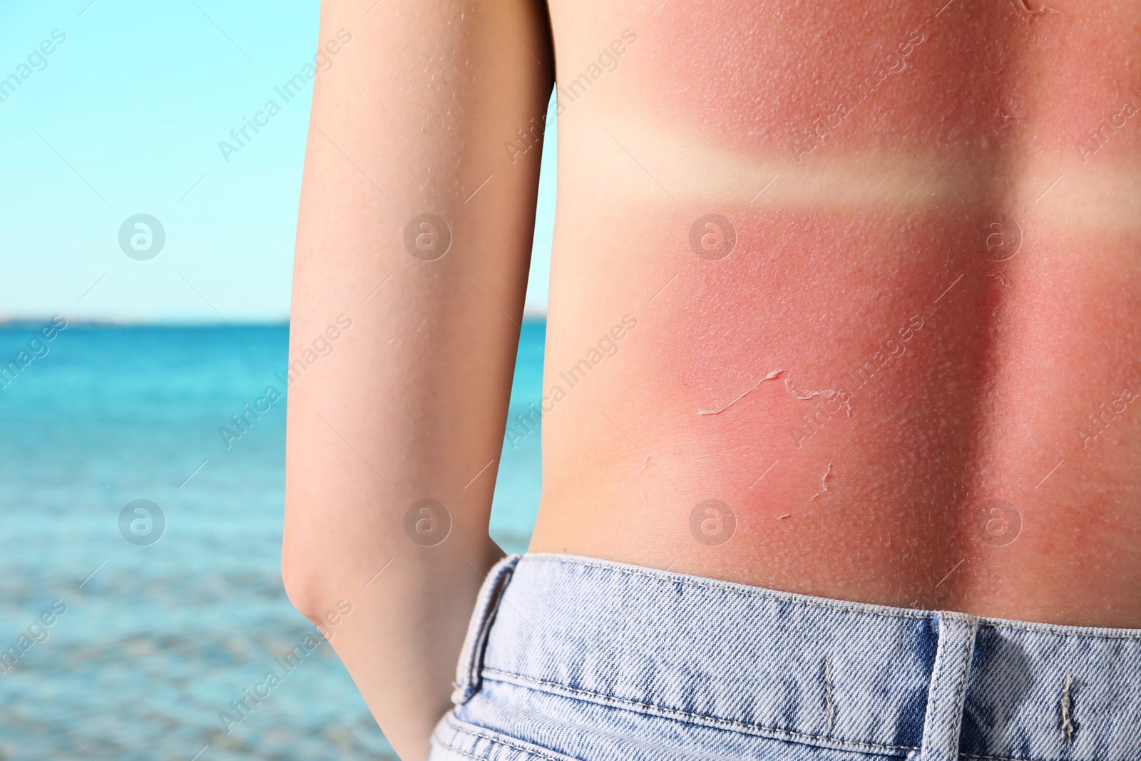 Woman with sunburned skin against sea, back view Image of Woman with sunburned skin against sea, back view
